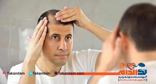 hair-loss-men