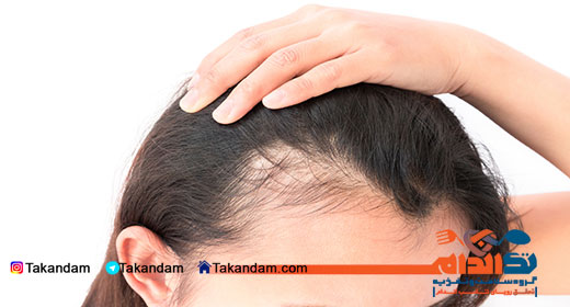 hair-loss-pattern