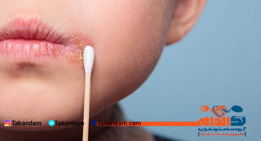 herpes-simplex-1