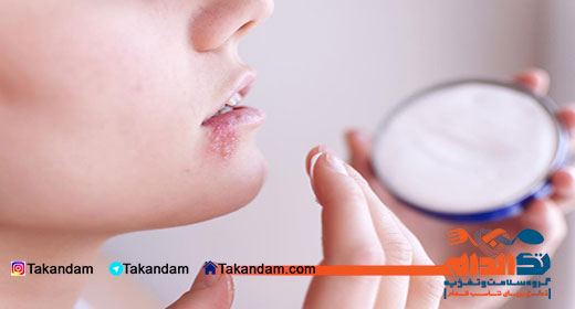 herpes-simplex-2