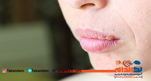herpes-simplex-3