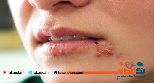 herpes-simplex-4