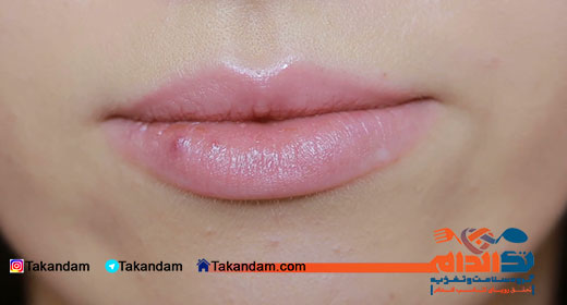 herpes-simplex-5