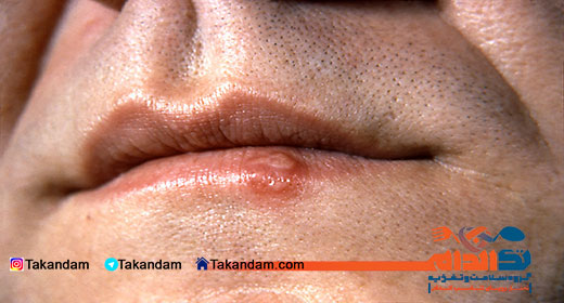 herpes-simplex-6