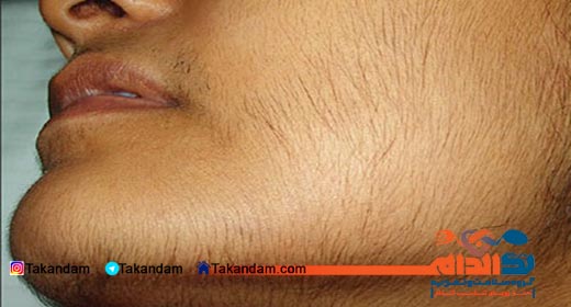 hormones-and-obesity-Hirsutism