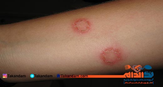 hyperglycemia-ring-worm