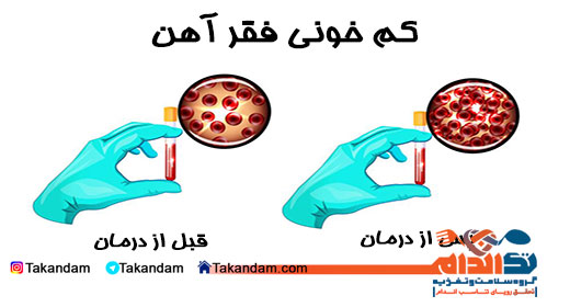 iron-deficiency-treatment