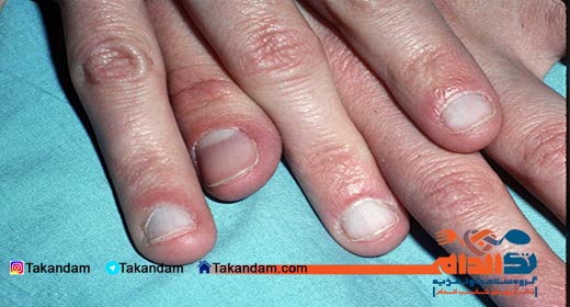 leukonychia-cause-and-treatment-2