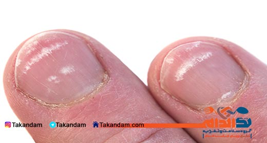 leukonychia-cause-and-treatment-3