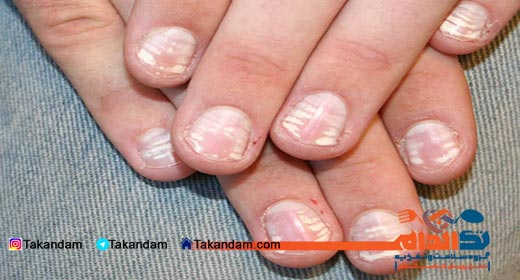 leukonychia-cause-and-treatment-4