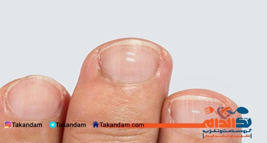 leukonychia-cause-and-treatment-5