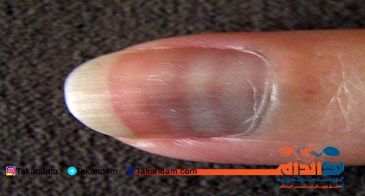 leukonychia-cause-and-treatment-7