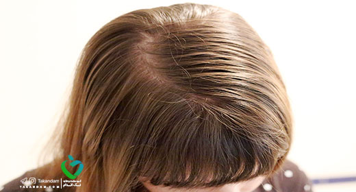oily-hair-6