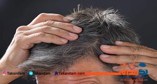 premature-greying-1