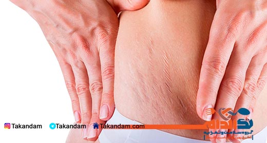 stretch-marks-nutrition-stretch-mark