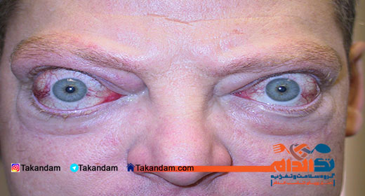 thyroid-during-pregnancy-eyes