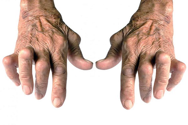 آرتروز یا ورم مفاصل