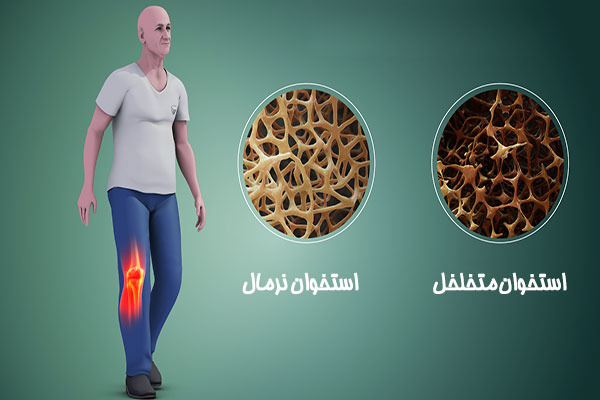 پوكي استخوان، آيا تغذيه صحيح راهي براي پيشگيري است؟