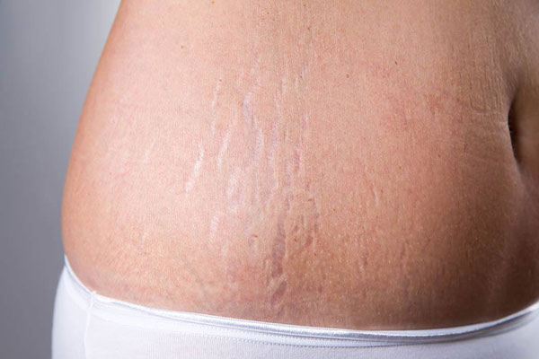 چگونه ترک های پوستی را برطرف کنیم؟