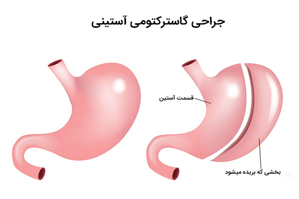 جراحی گاسترکتومی آستینی